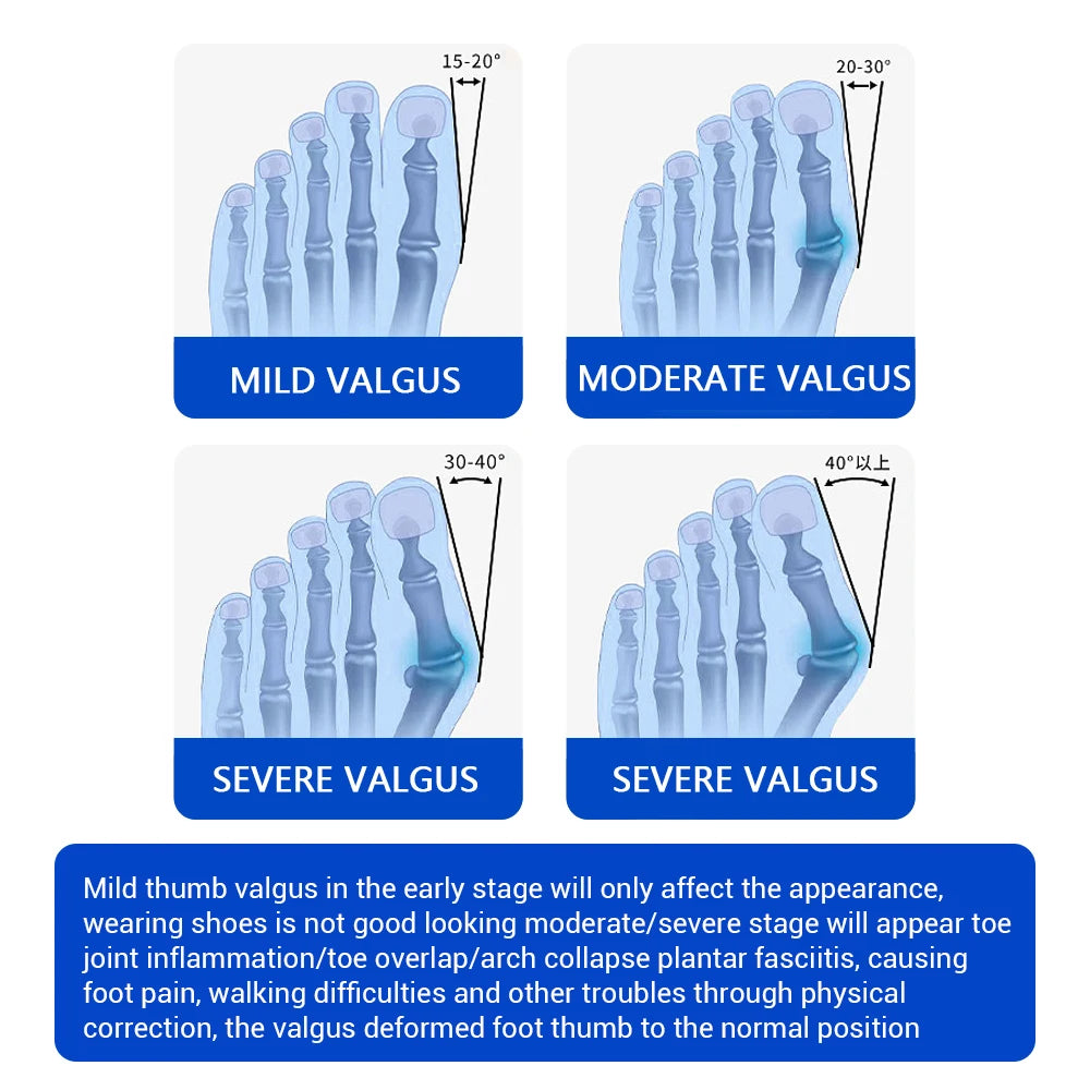 PastSky Bunion Corrector Toe Separator Orthotic Foot Care Device